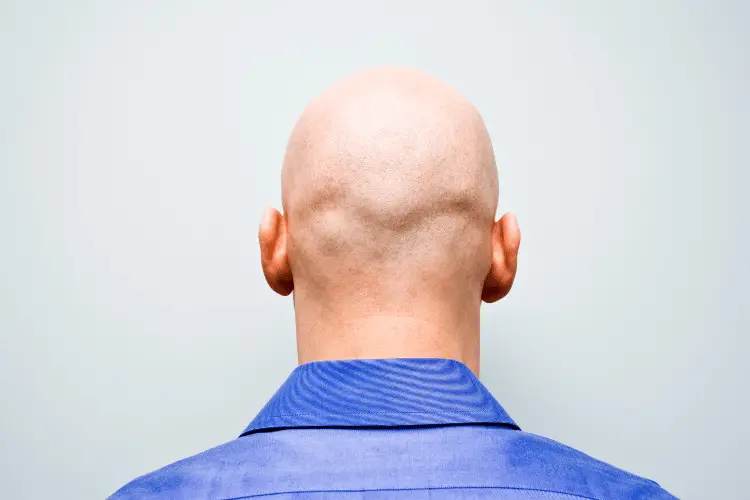 bald man's scalp 